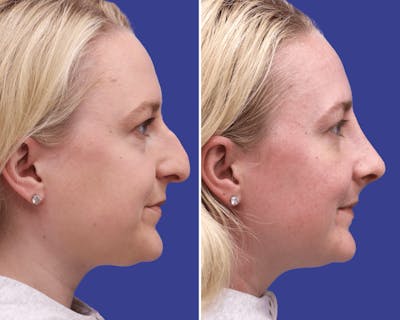 Rhinoplasty Before & After Gallery - Patient 140040 - Image 1