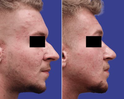Rhinoplasty Before & After Gallery - Patient 300053 - Image 1