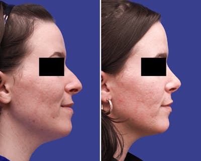 Rhinoplasty Before & After Gallery - Patient 222231 - Image 1