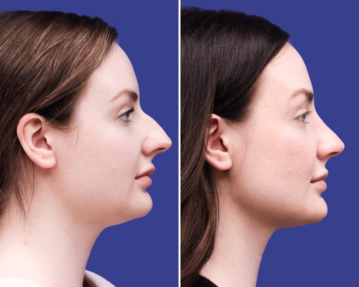 Rhinoplasty Before & After Gallery - Patient 236769 - Image 1