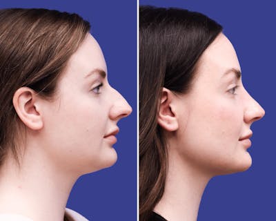 Rhinoplasty Before & After Gallery - Patient 236769 - Image 1