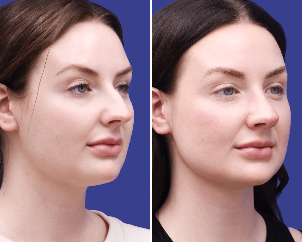 Rhinoplasty Before & After Gallery - Patient 236769 - Image 2