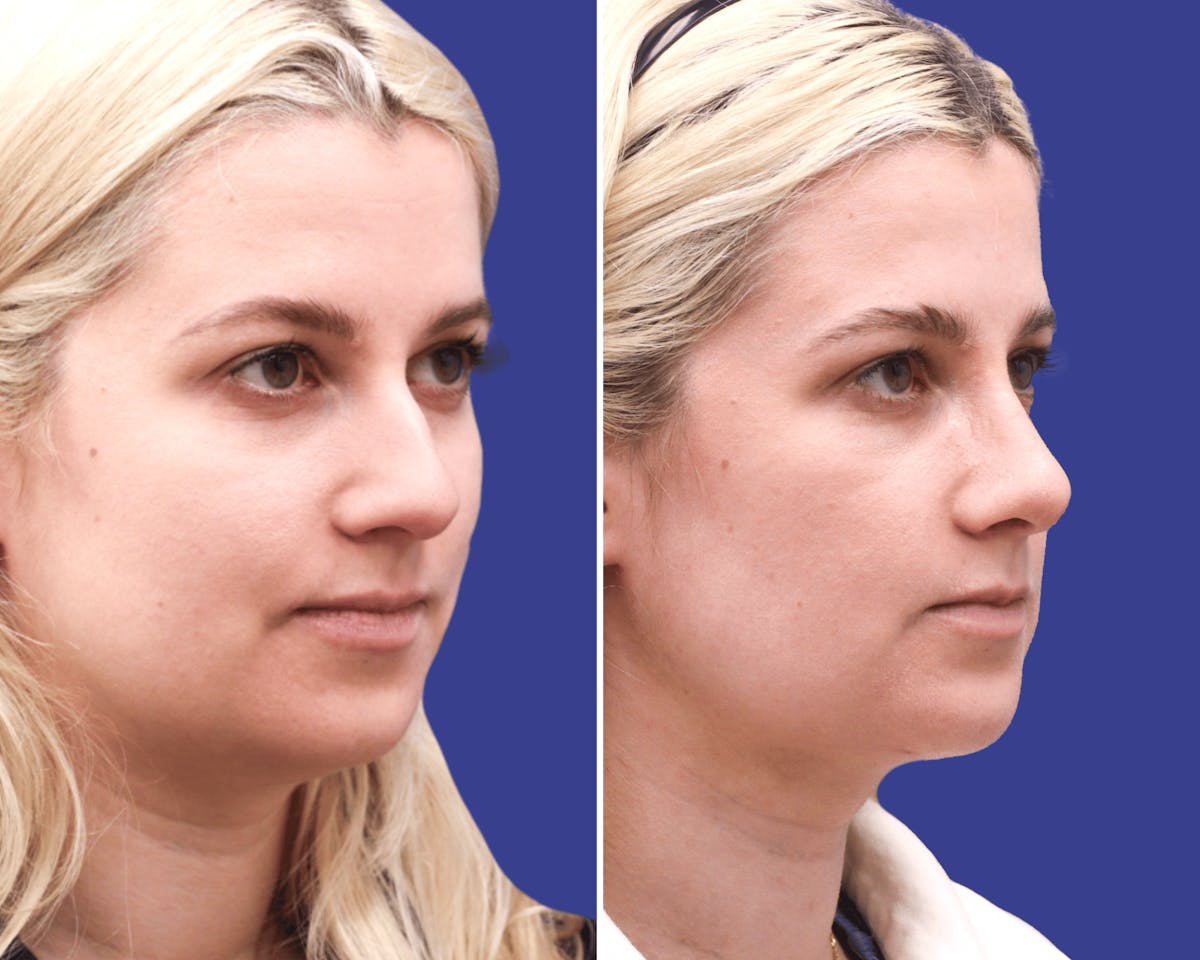 Rhinoplasty Before & After Gallery - Patient 265661 - Image 2