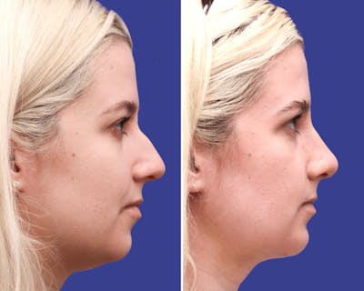 Rhinoplasty Before & After Gallery - Patient 265661 - Image 1