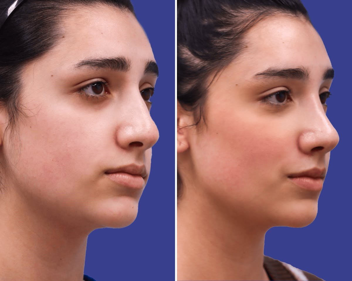 Rhinoplasty Before & After Gallery - Patient 364683 - Image 2