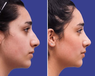 Rhinoplasty Before & After Gallery - Patient 364683 - Image 1