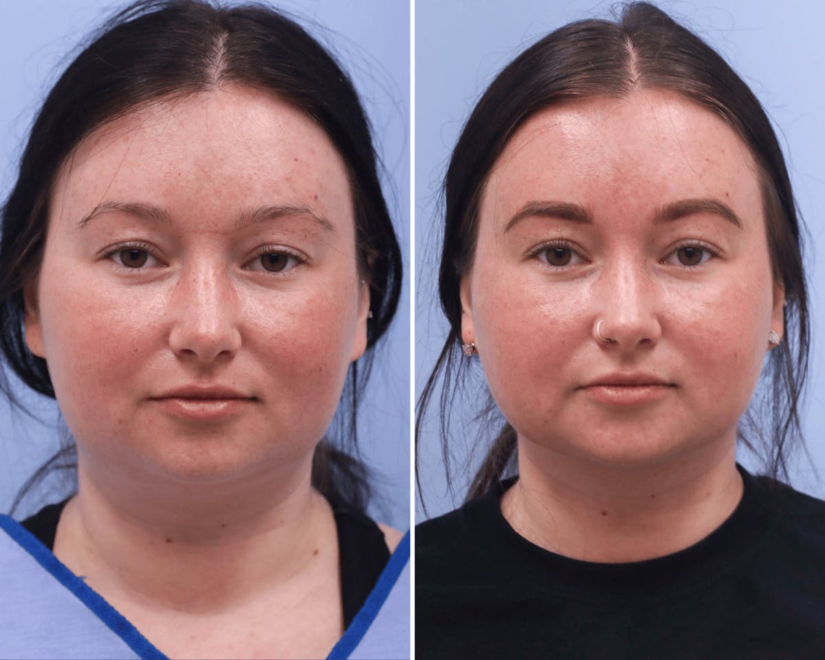 Submental Liposuction Before & After Gallery - Patient 275037 - Image 3