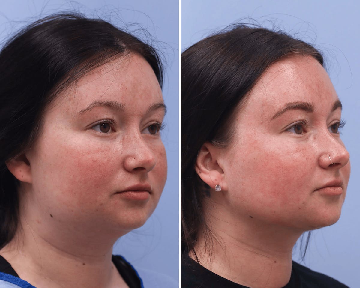 Submental Liposuction Before & After Gallery - Patient 275037 - Image 2