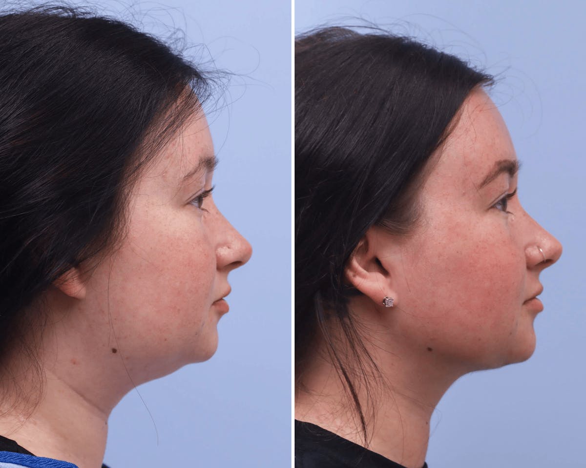 Submental Liposuction Before & After Gallery - Patient 275037 - Image 1