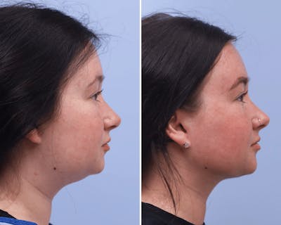 Neck Before & After Gallery - Patient 340961 - Image 1