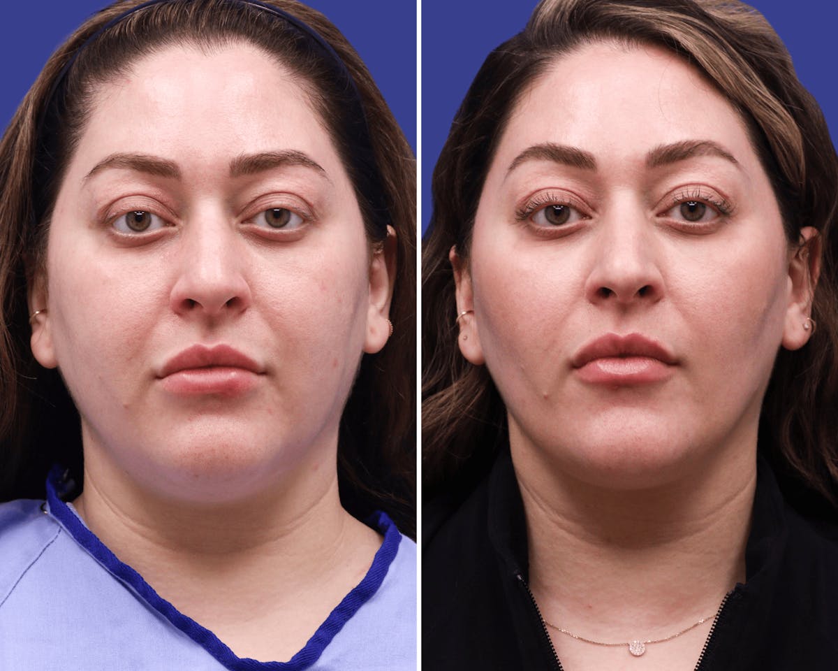 Neck Before & After Gallery - Patient 386610 - Image 3