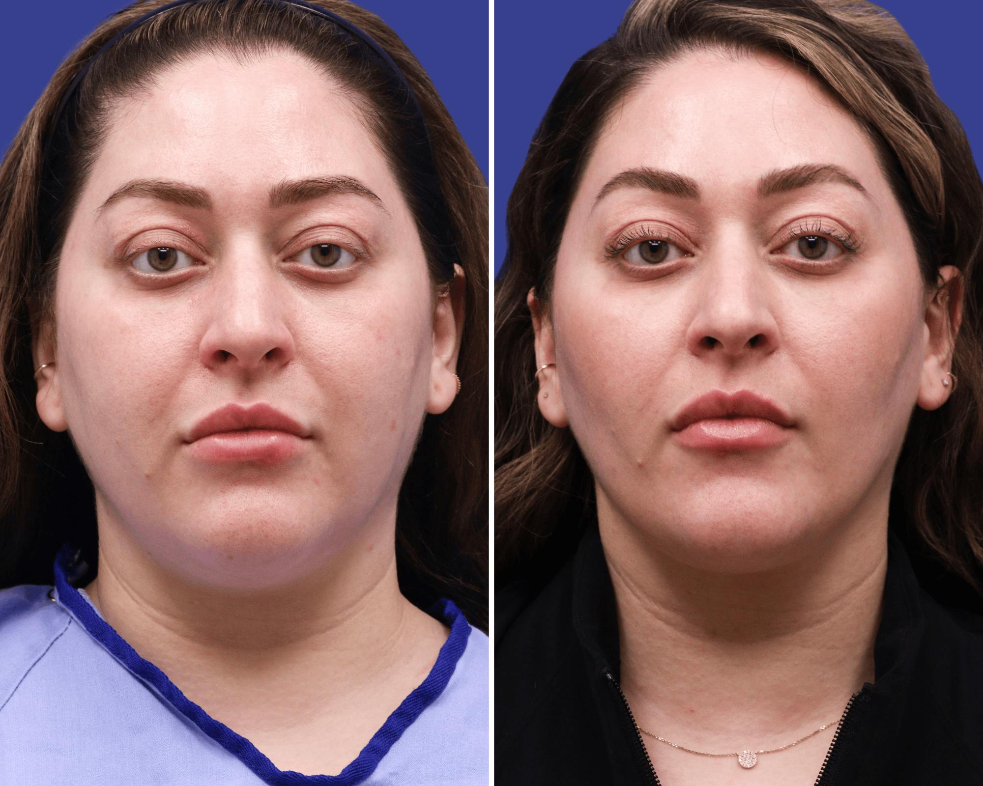 Submental Liposuction Before & After Gallery - Patient 107757 - Image 3