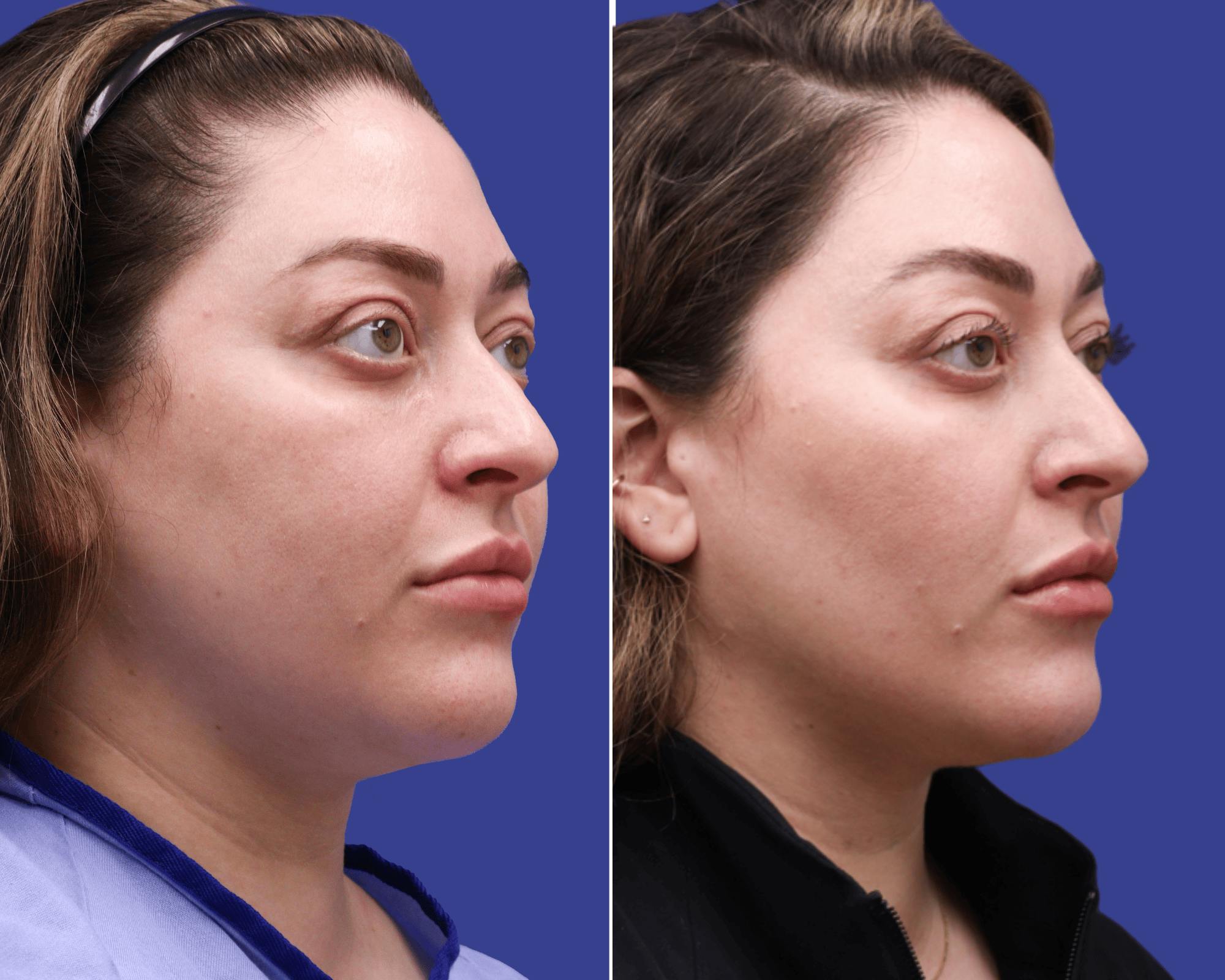 Submental Liposuction Before & After Gallery - Patient 107757 - Image 2