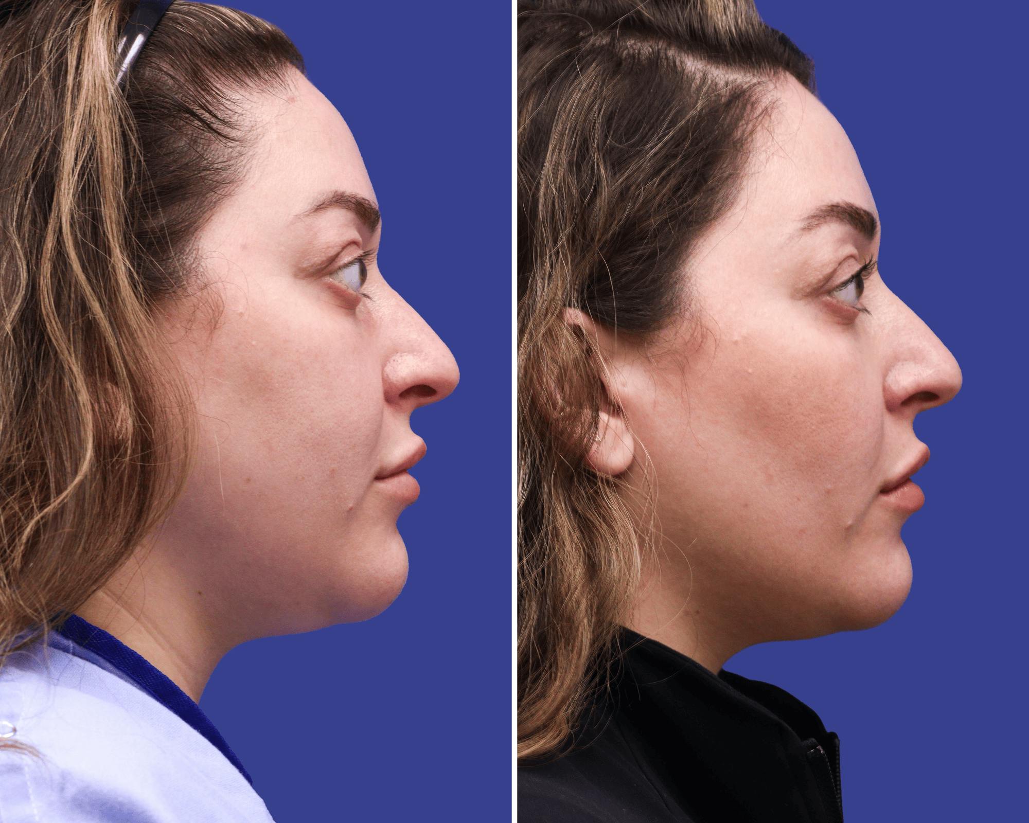 Submental Liposuction Before & After Gallery - Patient 107757 - Image 1