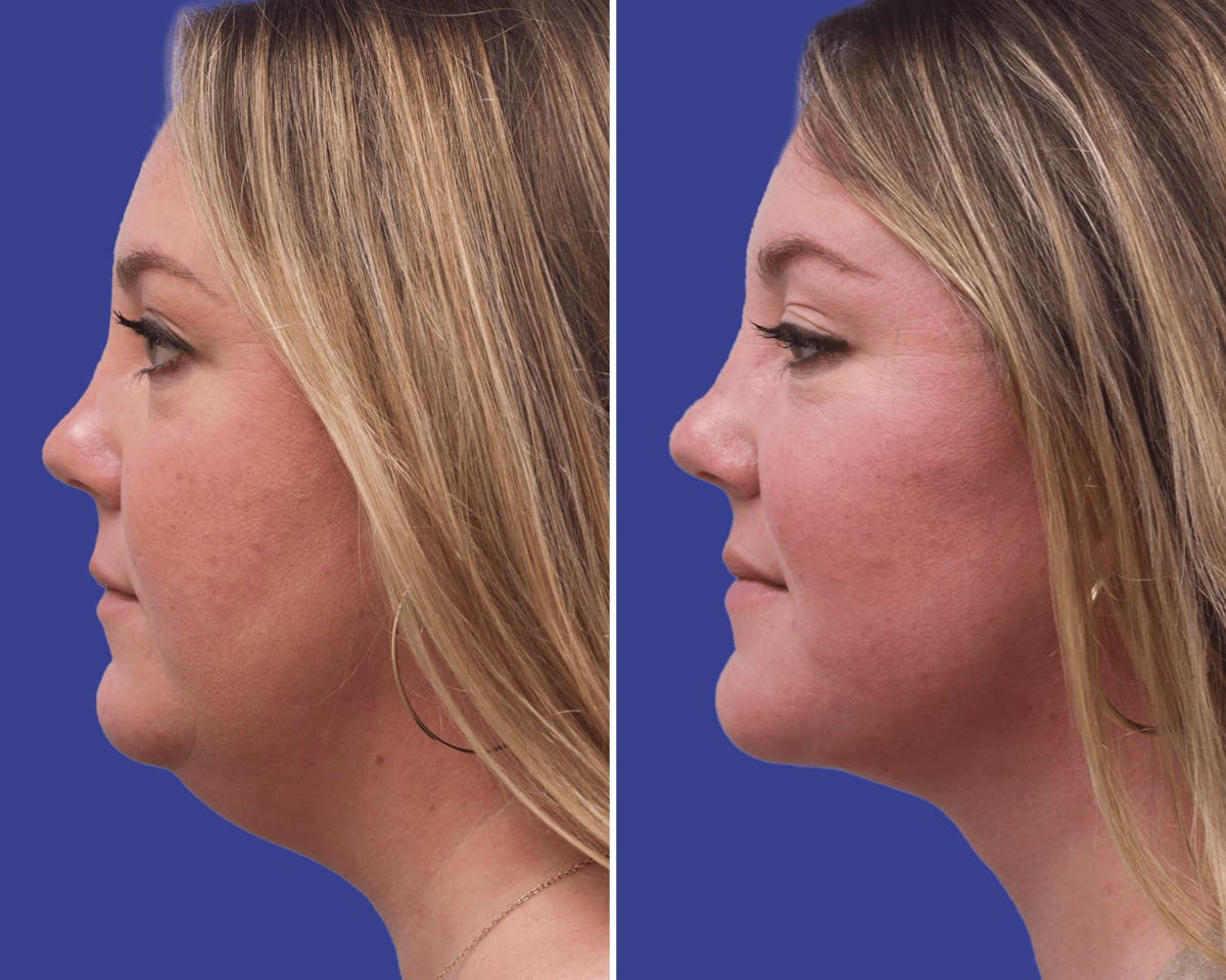 Neck Before & After Gallery - Patient 255524 - Image 1