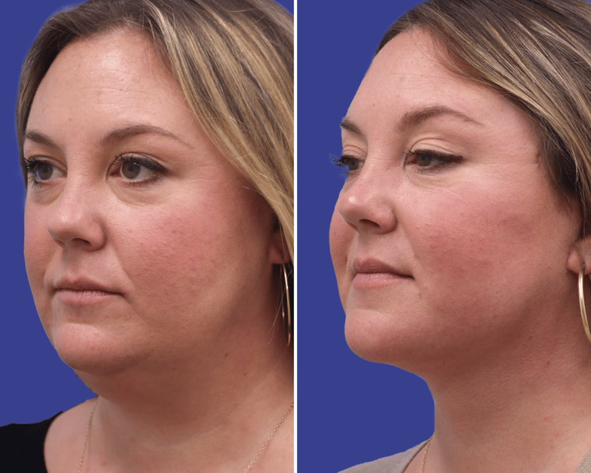 Neck Before & After Gallery - Patient 255524 - Image 2