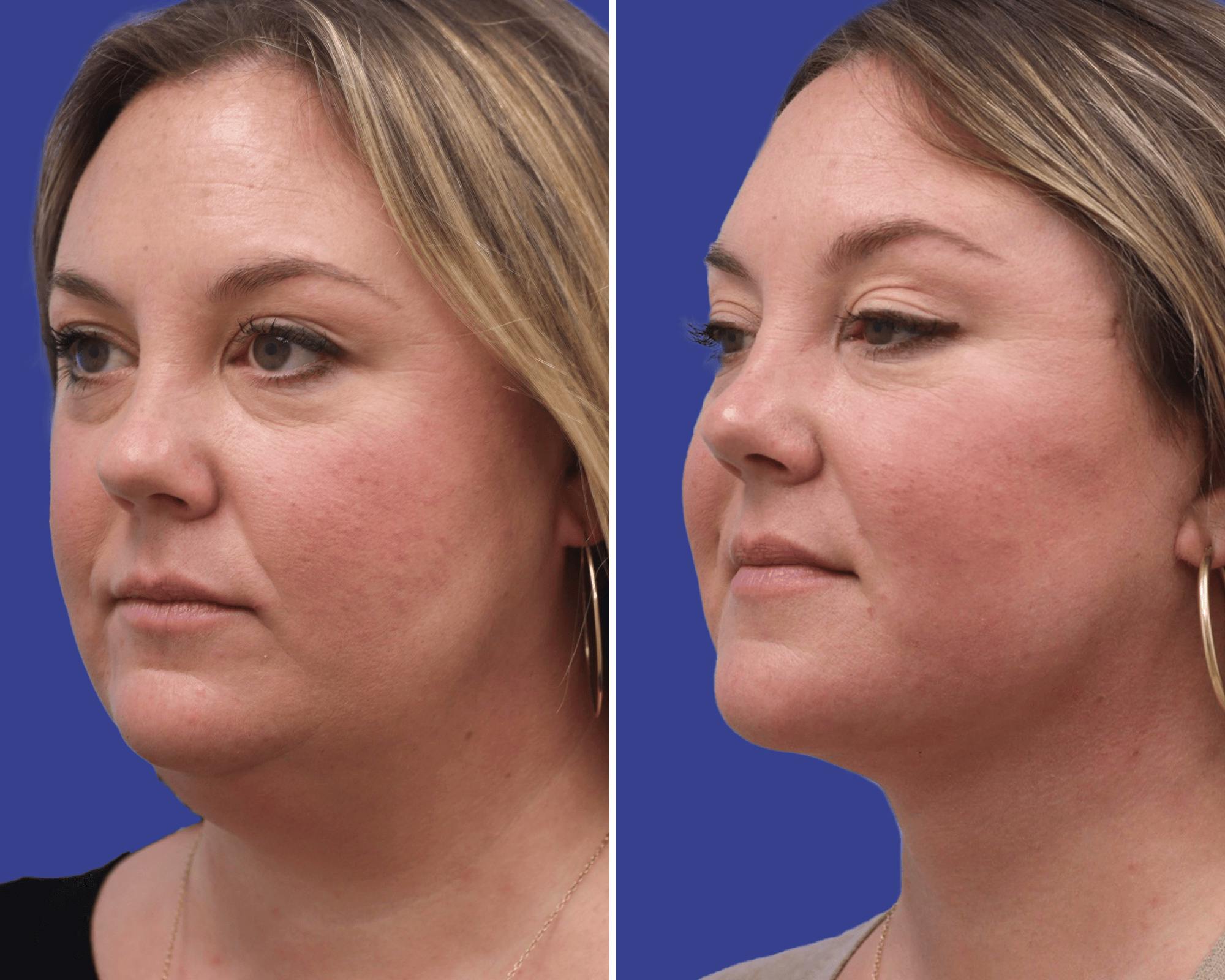 Submental Liposuction Before & After Gallery - Patient 379141 - Image 2