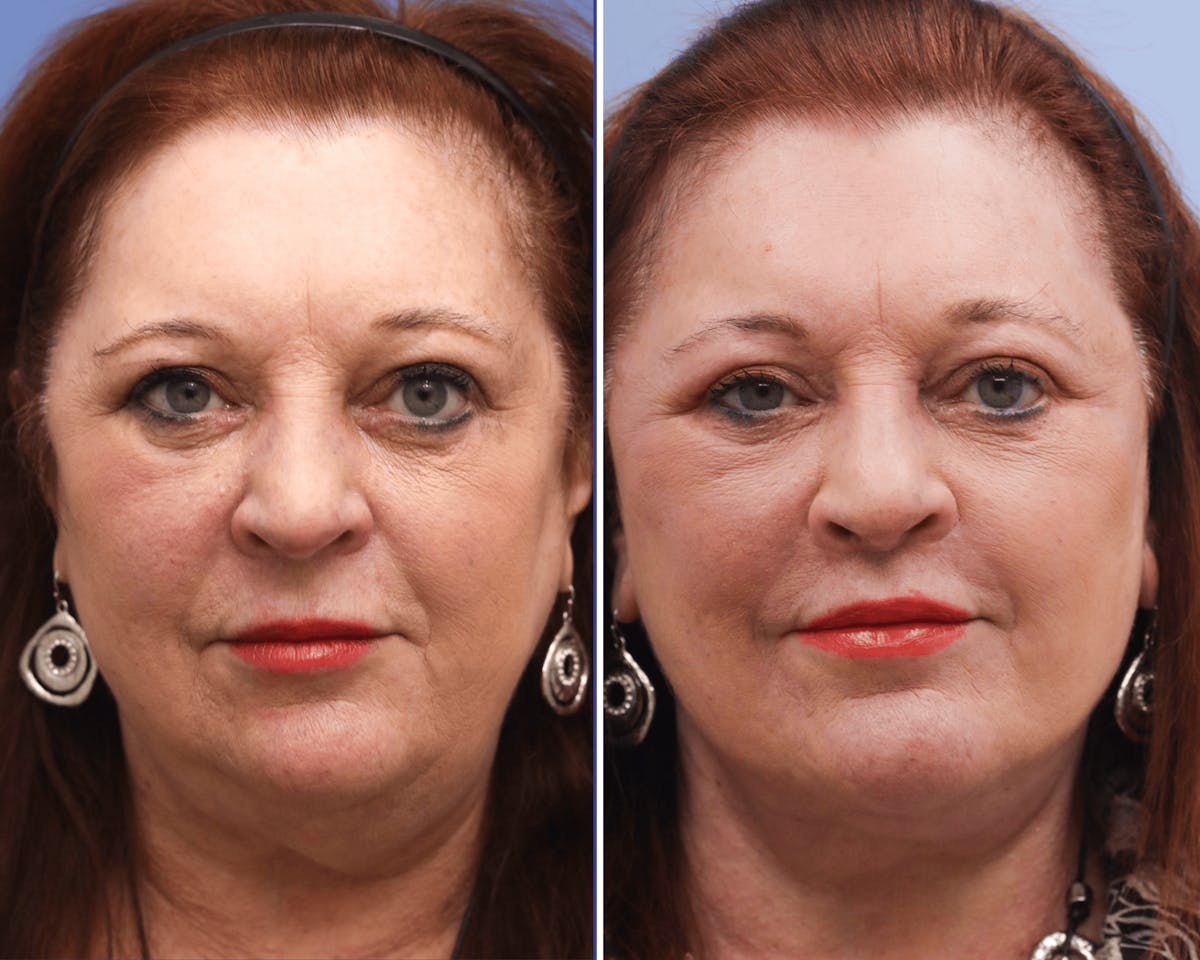 Neck Before & After Gallery - Patient 220335 - Image 3