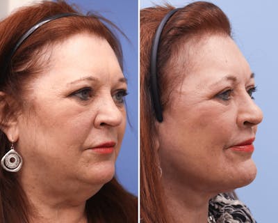 Neck Before & After Gallery - Patient 220335 - Image 1