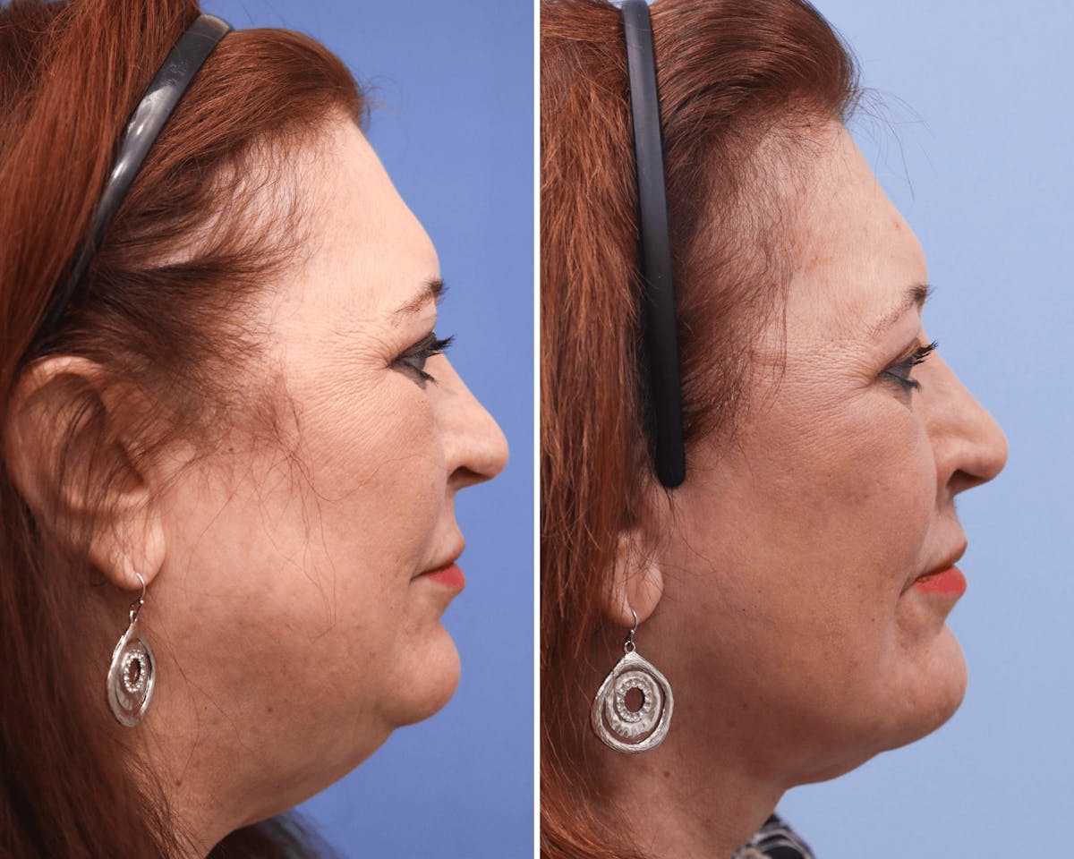 Neck Before & After Gallery - Patient 220335 - Image 2
