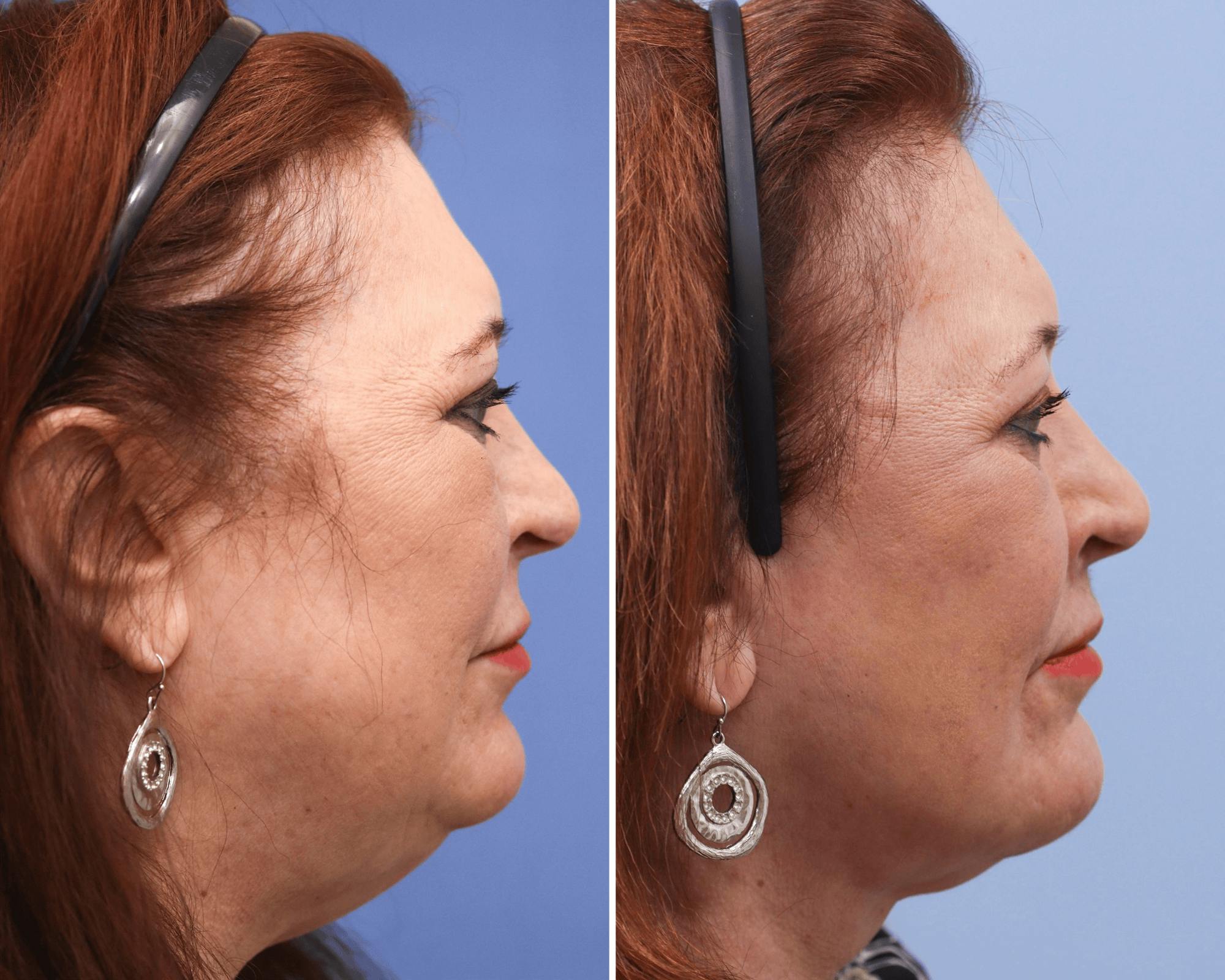 Neck Lift Before & After Gallery - Patient 146014 - Image 2