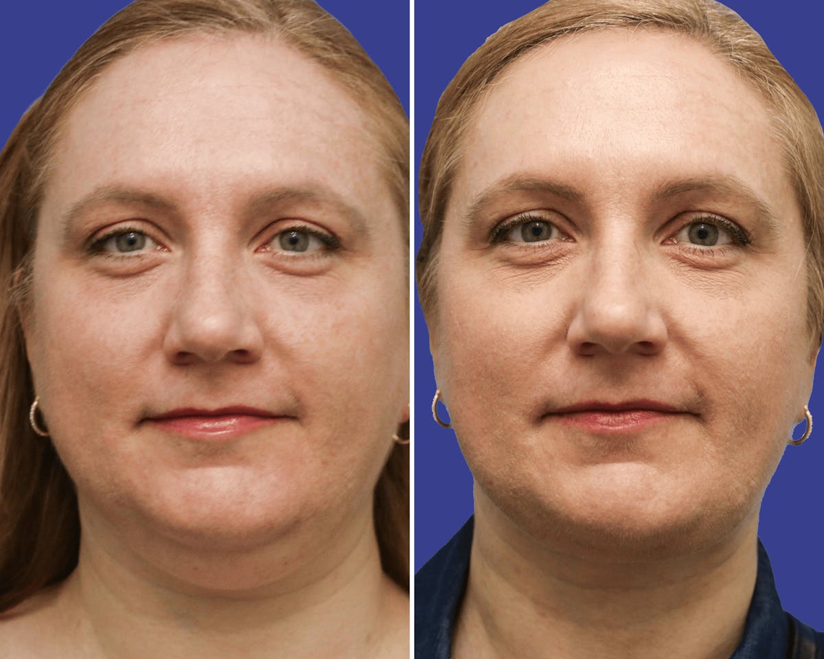 Neck Before & After Gallery - Patient 186697 - Image 3