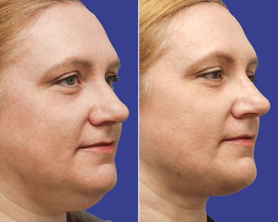 Neck Before & After Gallery - Patient 186697 - Image 1