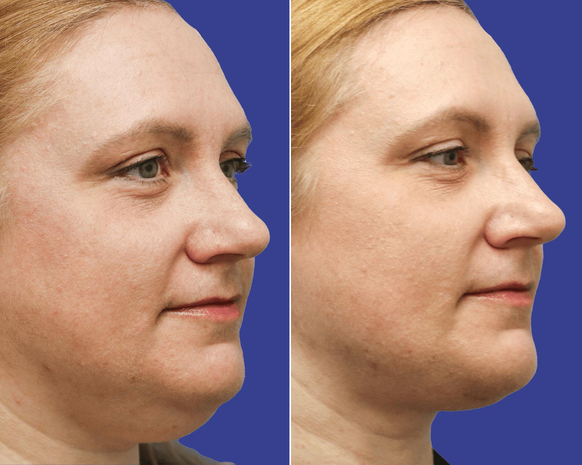 Neck Lift Before & After Gallery - Patient 130218 - Image 1