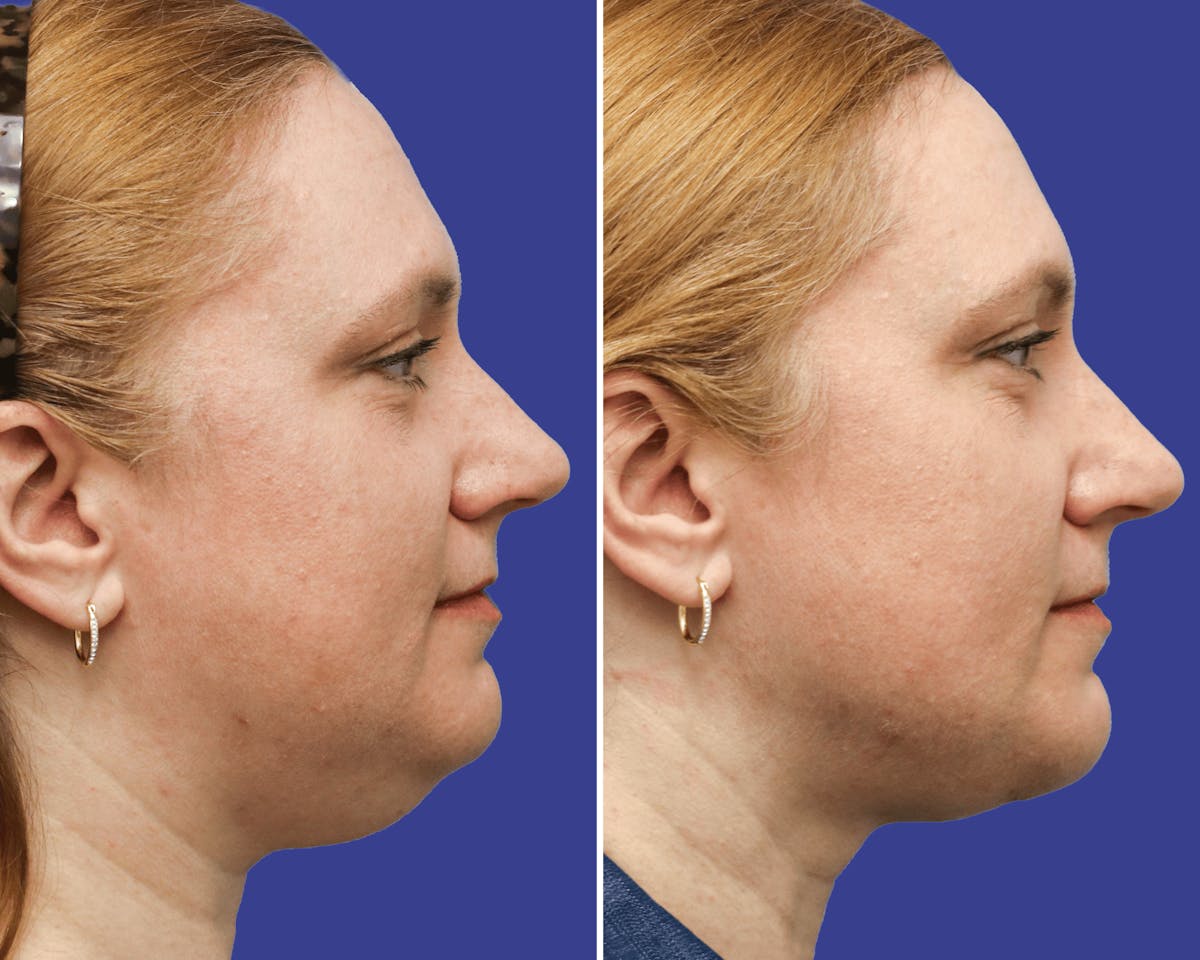 Neck Before & After Gallery - Patient 186697 - Image 2