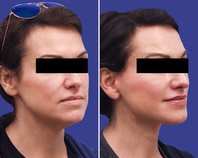 Neck Before & After Gallery - Patient 170294 - Image 1
