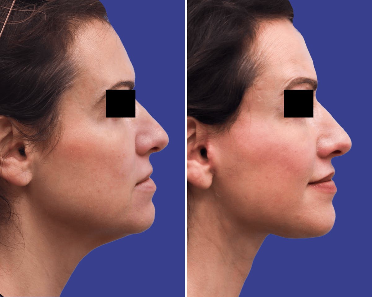 Neck Before & After Gallery - Patient 170294 - Image 2