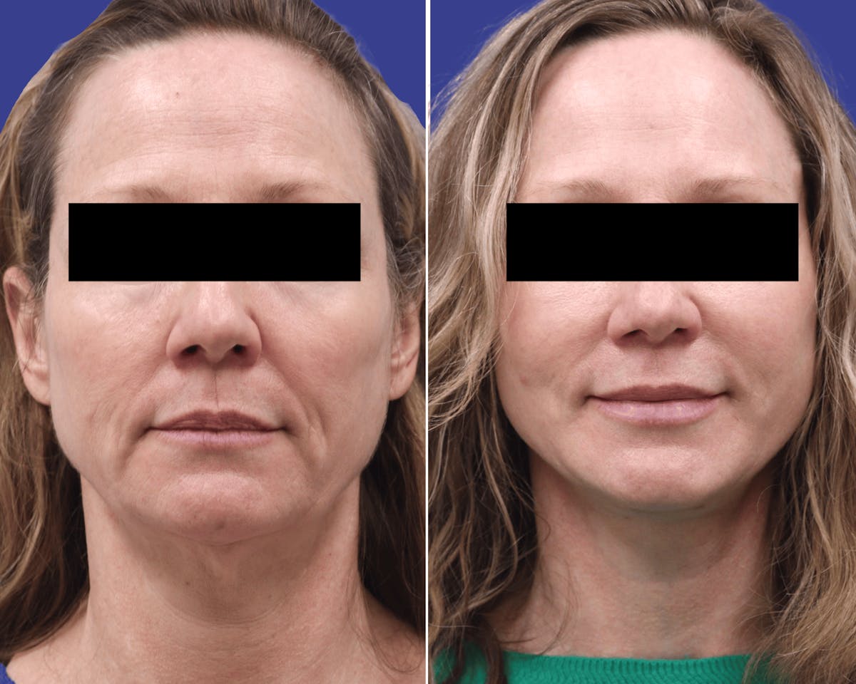 Neck Before & After Gallery - Patient 378895 - Image 3