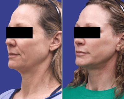 Neck Before & After Gallery - Patient 378895 - Image 1