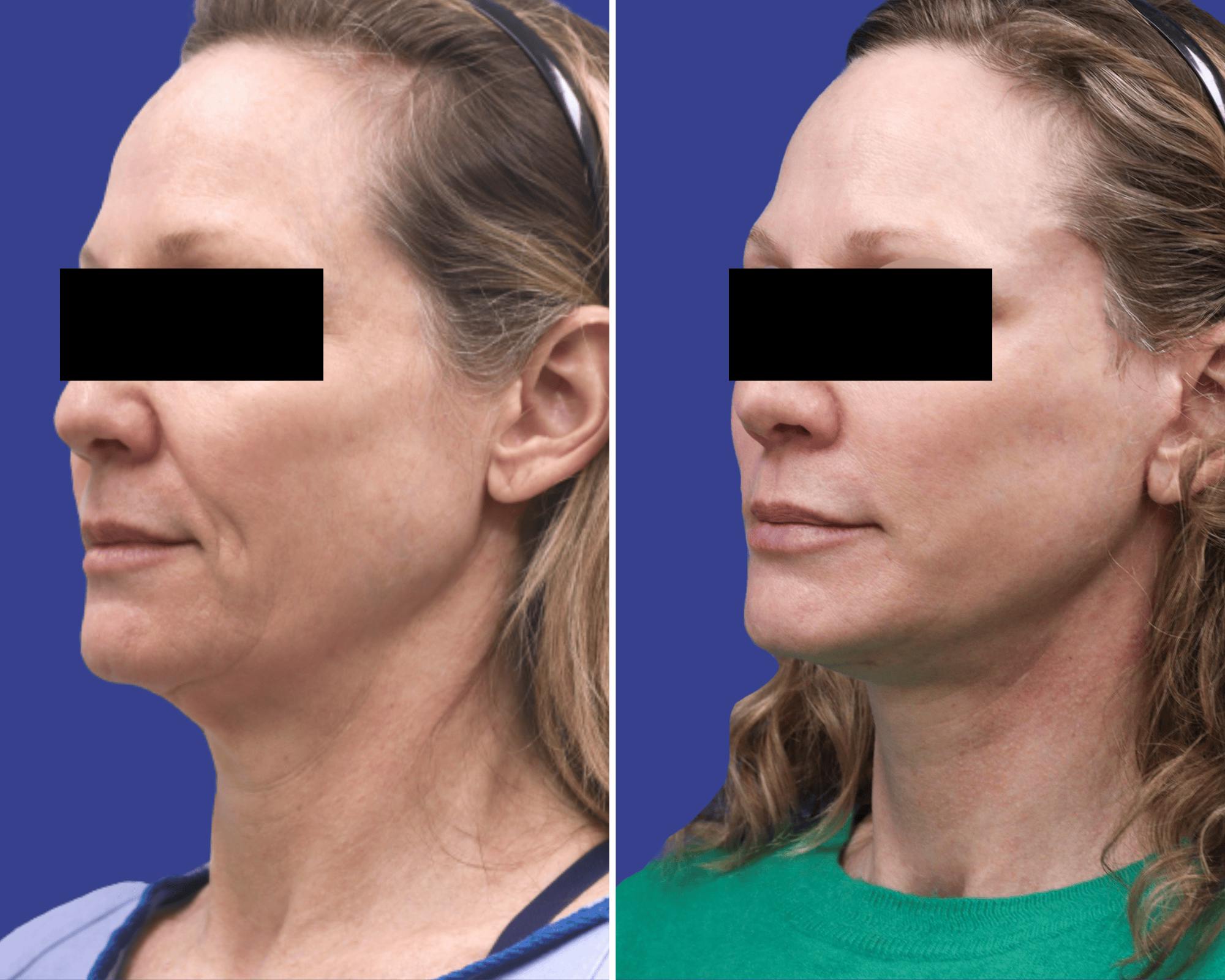Neck Lift Before & After Gallery - Patient 197540 - Image 1