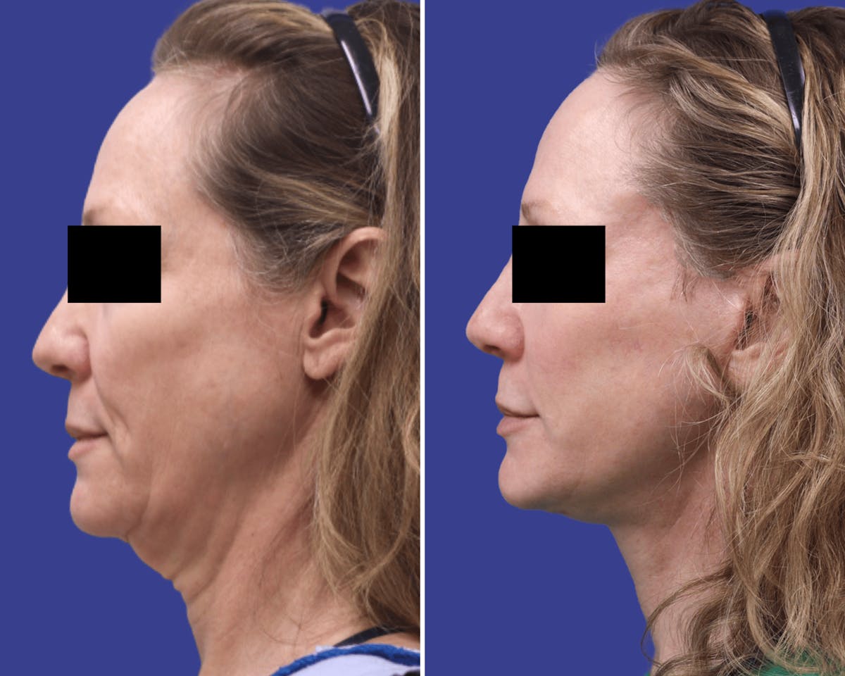 Neck Before & After Gallery - Patient 378895 - Image 2