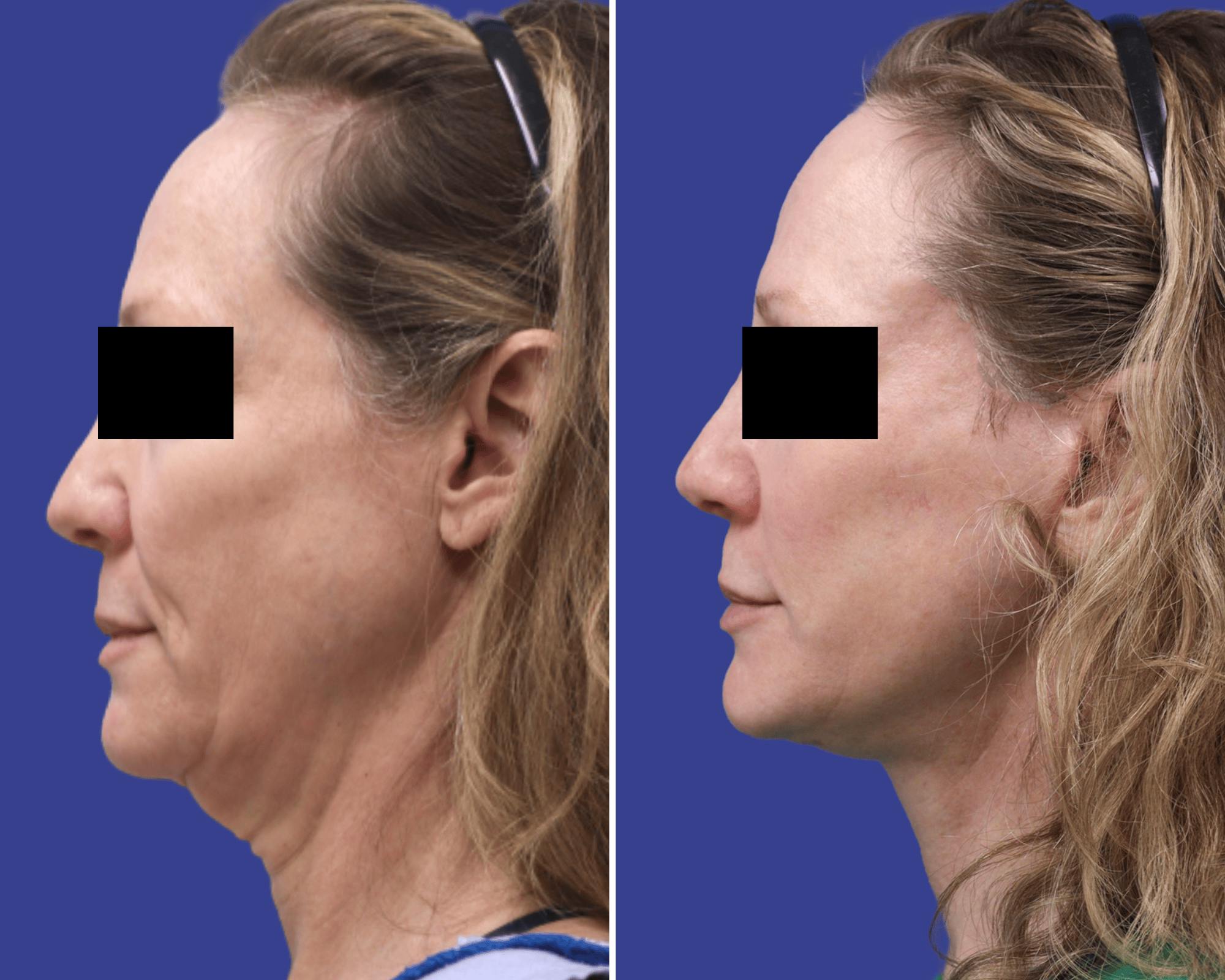 Neck Lift Before & After Gallery - Patient 197540 - Image 2