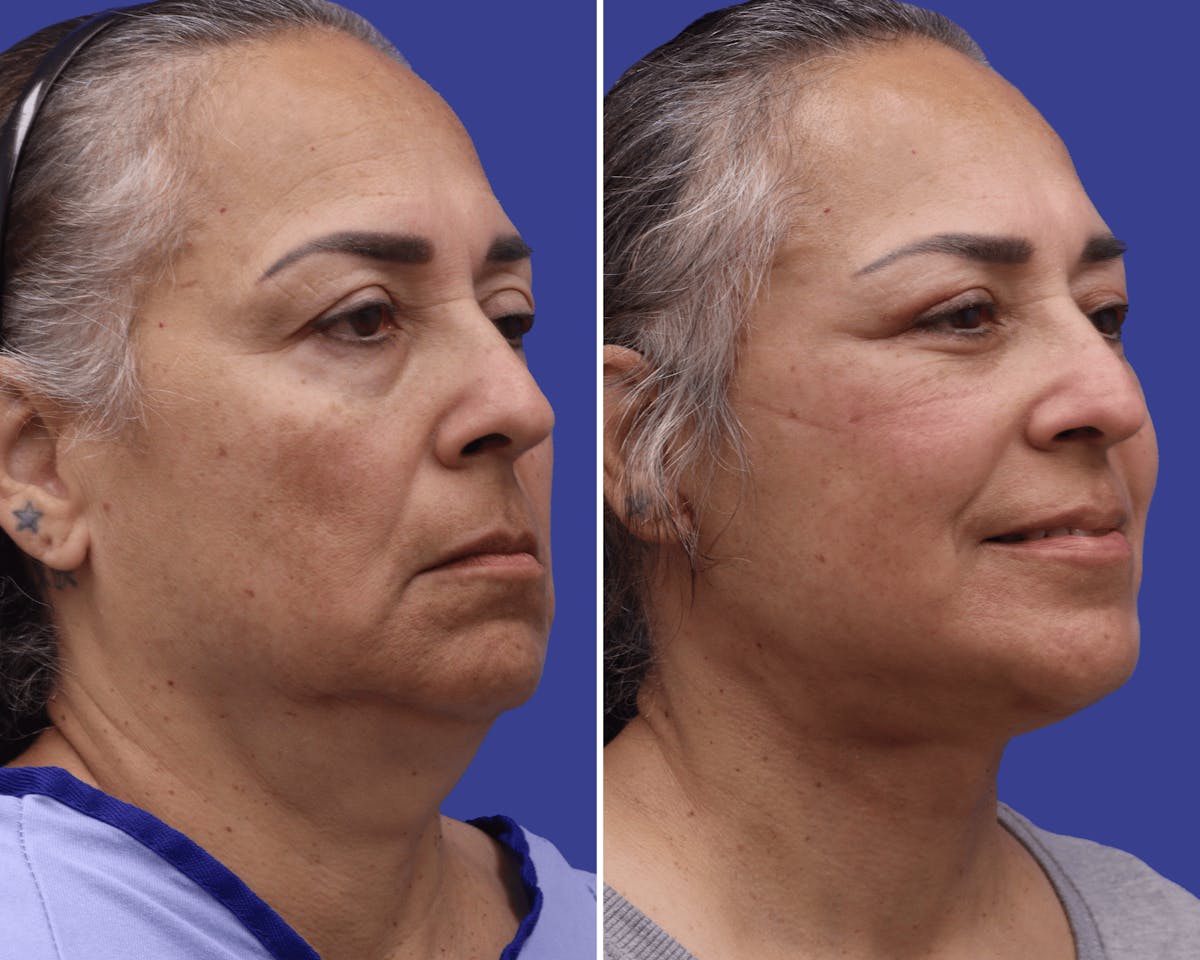 Neck Before & After Gallery - Patient 381988 - Image 1