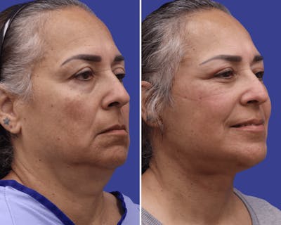 Neck Before & After Gallery - Patient 381988 - Image 1