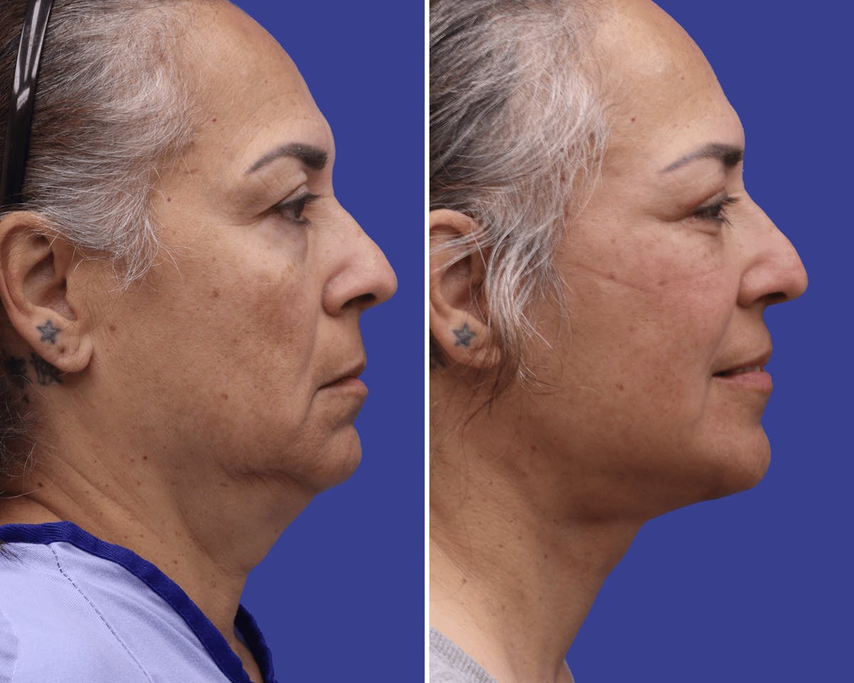 Neck Before & After Gallery - Patient 381988 - Image 2