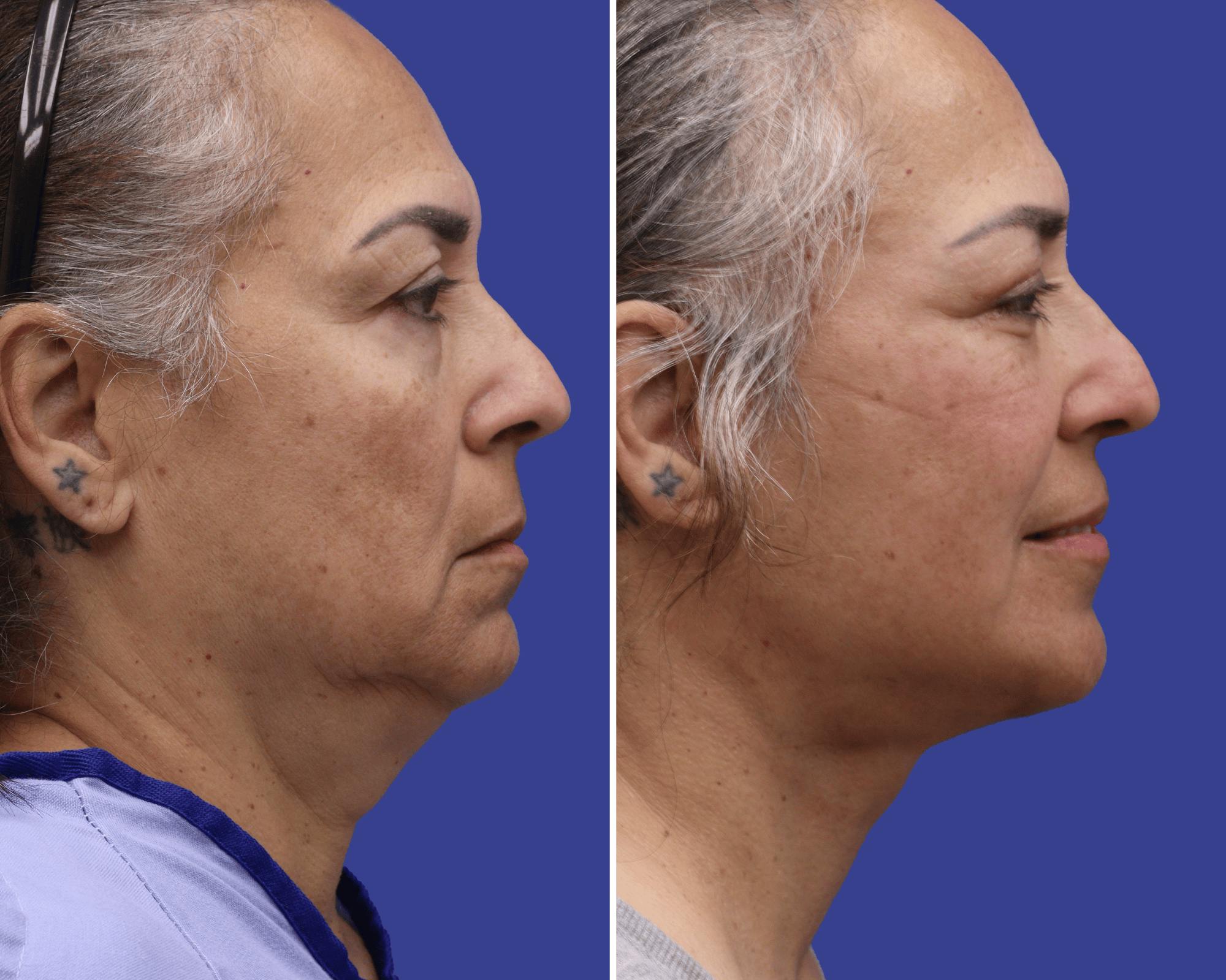 Neck Lift Before & After Gallery - Patient 170293 - Image 2