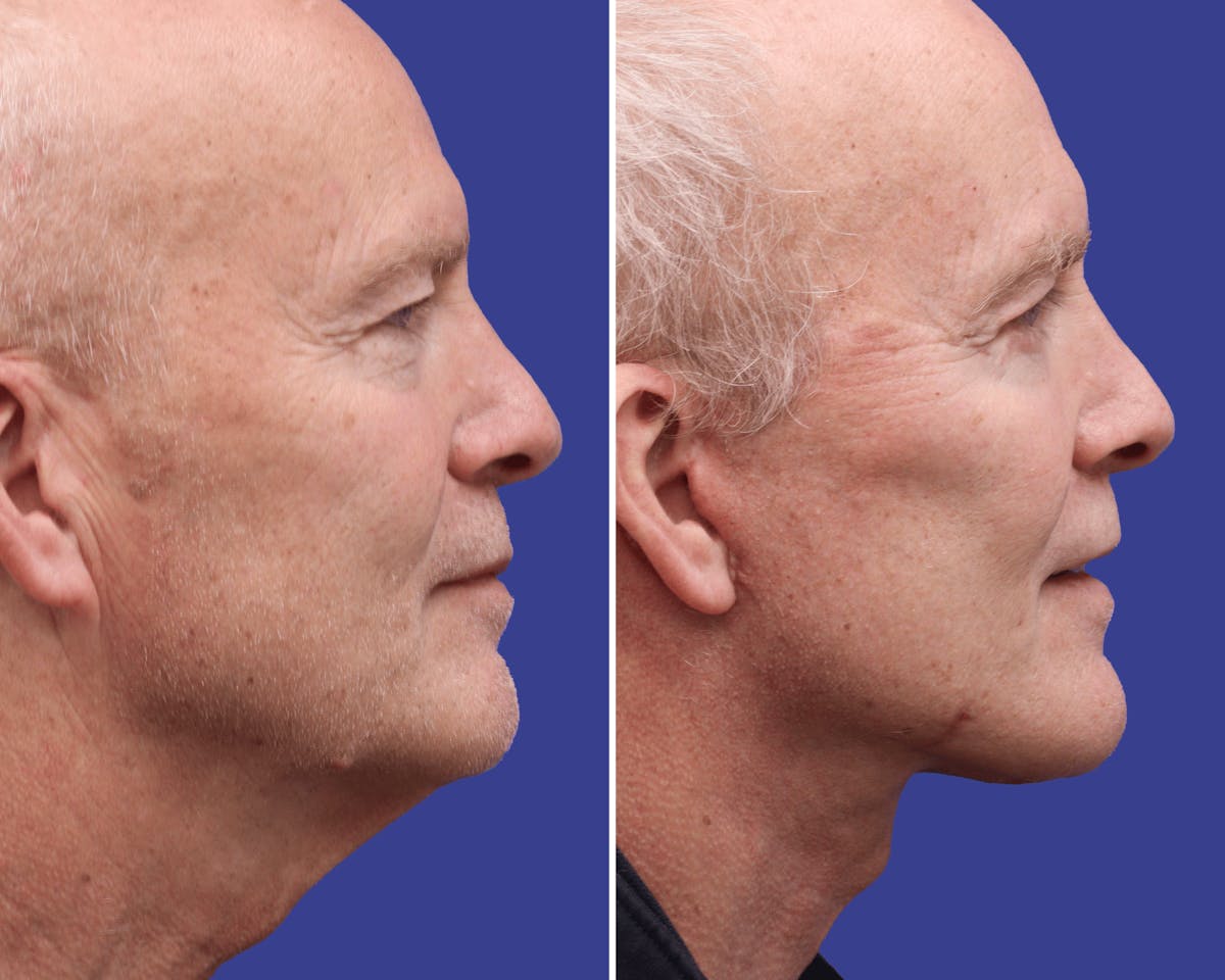 Neck Before & After Gallery - Patient 279517 - Image 2