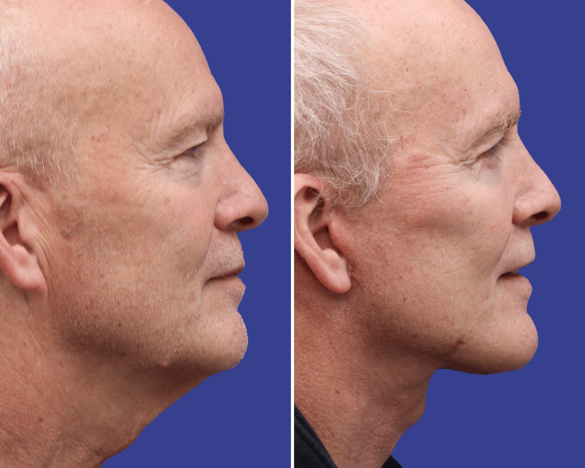 Neck Lift Before & After Gallery - Patient 106310 - Image 2