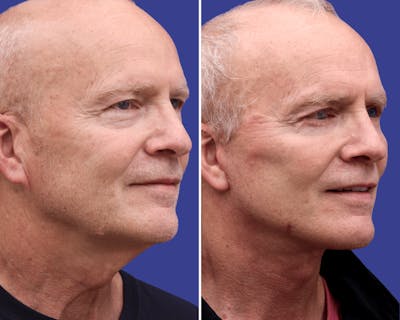 Neck Before & After Gallery - Patient 279517 - Image 1