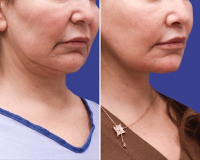 Neck Before & After Gallery - Patient 387226 - Image 1