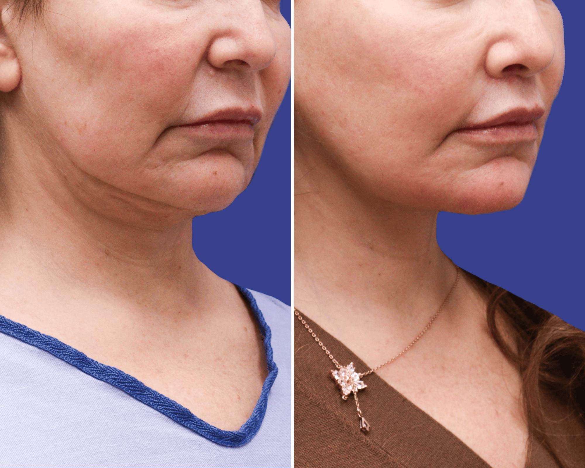 Neck Lift Before & After Gallery - Patient 364595 - Image 1