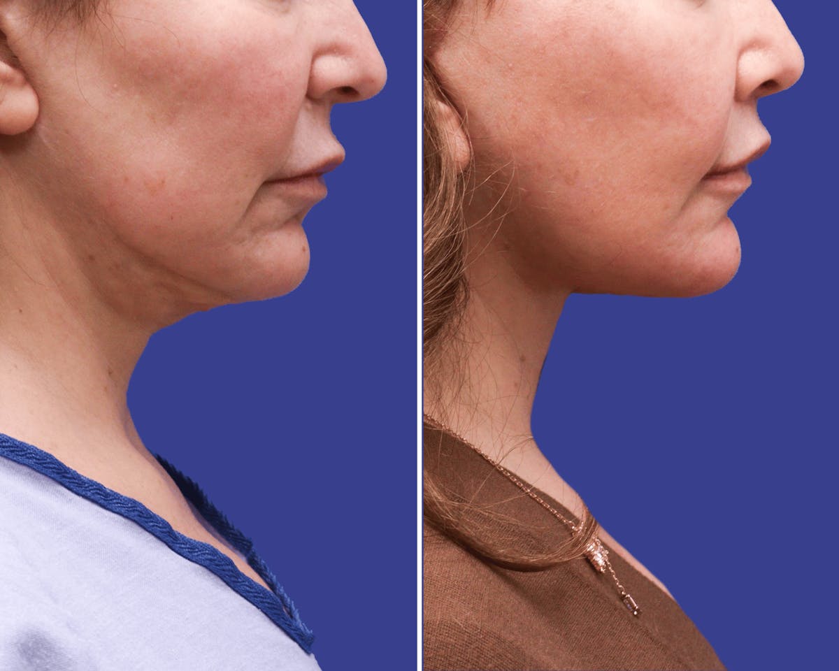 Neck Lift Before & After Gallery - Patient 364595 - Image 2