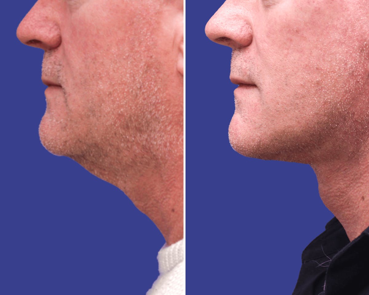 Neck Before & After Gallery - Patient 664172 - Image 2
