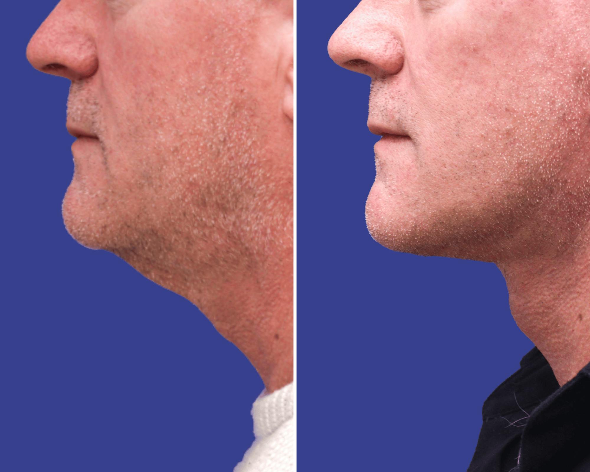 Neck Lift Before & After Gallery - Patient 404128 - Image 2