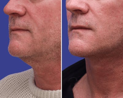 Neck Before & After Gallery - Patient 664172 - Image 1