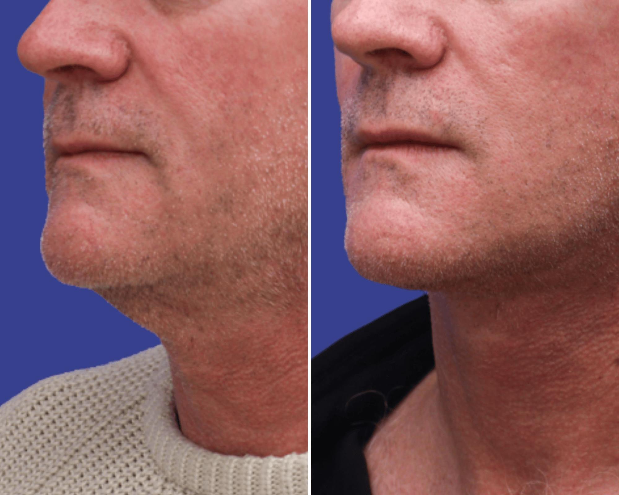Neck Lift Before & After Gallery - Patient 404128 - Image 1